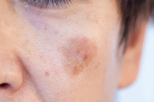 レーザーでシミが悪化する人の共通点