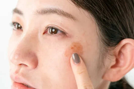 シミだけ消そうとすると高確率で再発する理由